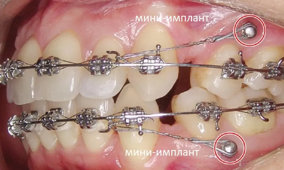 Мини импланты в ортодонтии